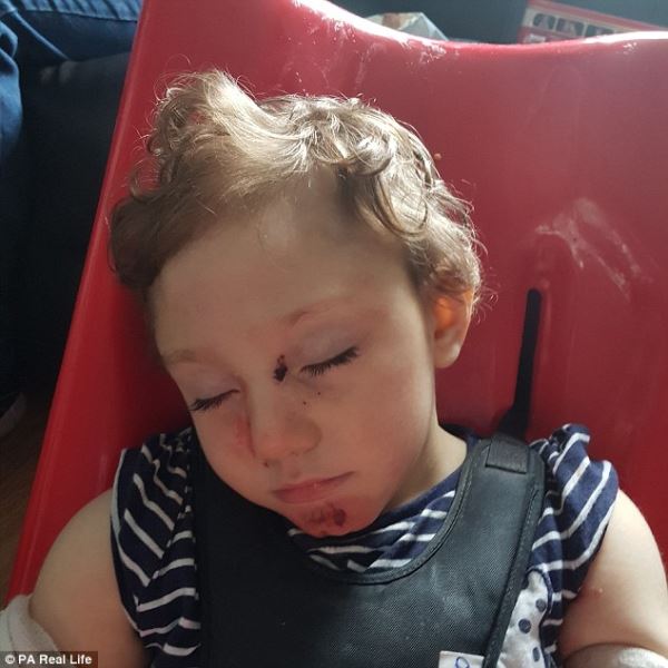 Как живет девочка, которой после рождения из-за редкой аномалии удалили большую часть мозга