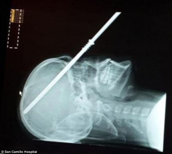 Британский подросток чудом выжил, пронзив себе череп насквозь гарпуном