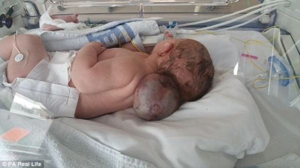 Как живет девочка, которой после рождения из-за редкой аномалии удалили большую часть мозга