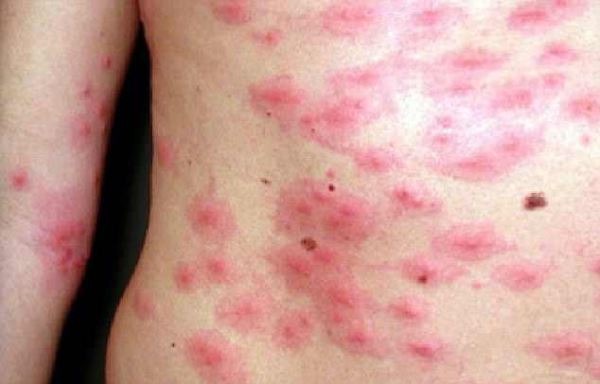 Юго-восток Великобритании заполонили опасные для человека гусеницы