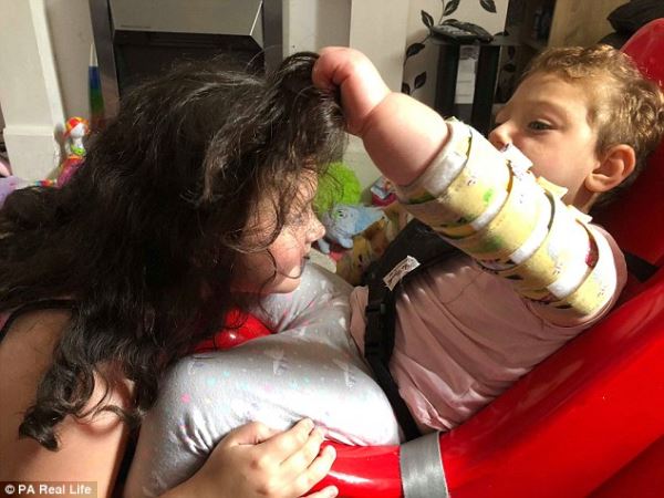 Как живет девочка, которой после рождения из-за редкой аномалии удалили большую часть мозга