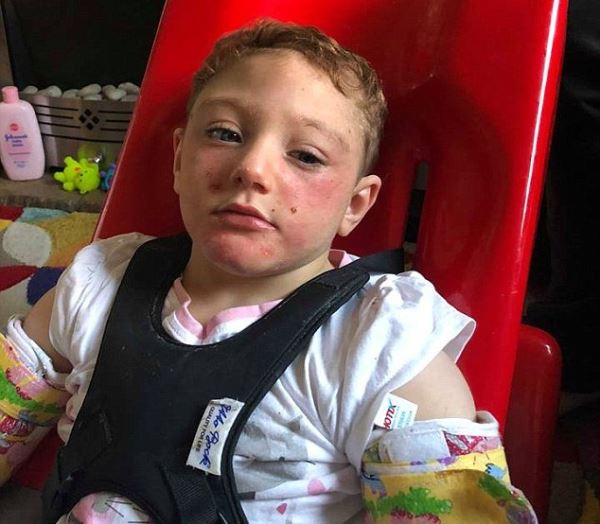 Как живет девочка, которой после рождения из-за редкой аномалии удалили большую часть мозга