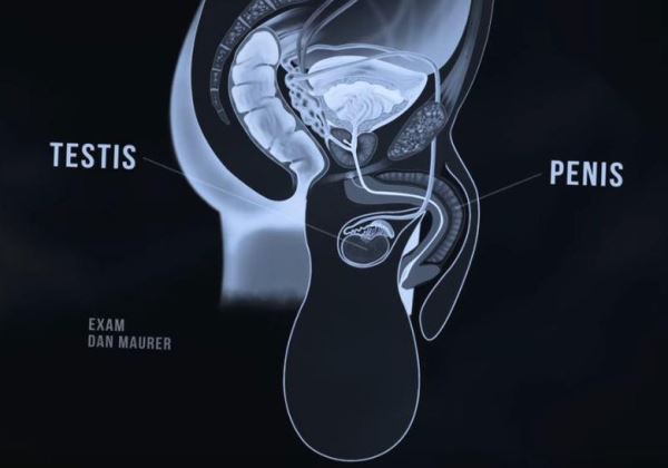 Мужчина 9 лет прожил с огромной мошонкой, весившей 36 кг