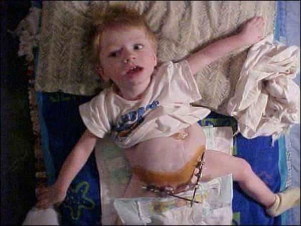 Родившийся с кучей патологий и почти всеми органами наружу мальчик отпраздновал свое 17-летие