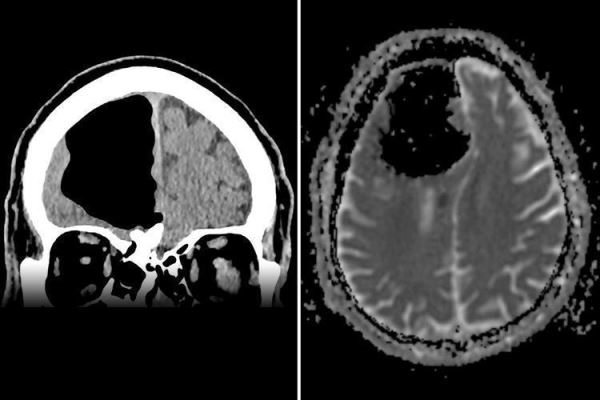 Ирландец жил с "дыркой в мозгу" и испытывал лишь проблемы с координацией