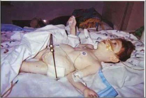 Родившийся с кучей патологий и почти всеми органами наружу мальчик отпраздновал свое 17-летие