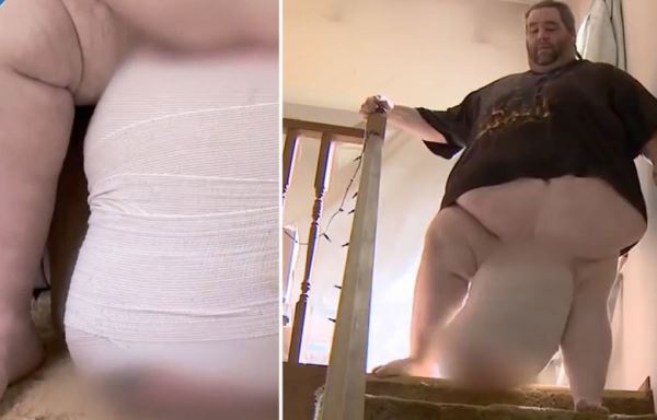 Мужчина 9 лет прожил с огромной мошонкой, весившей 36 кг